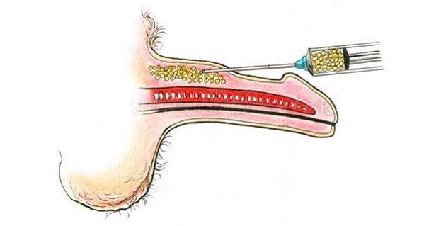 Injekcie kyseliny hyalurónovej do hlavne člena, aby sa zvýšila